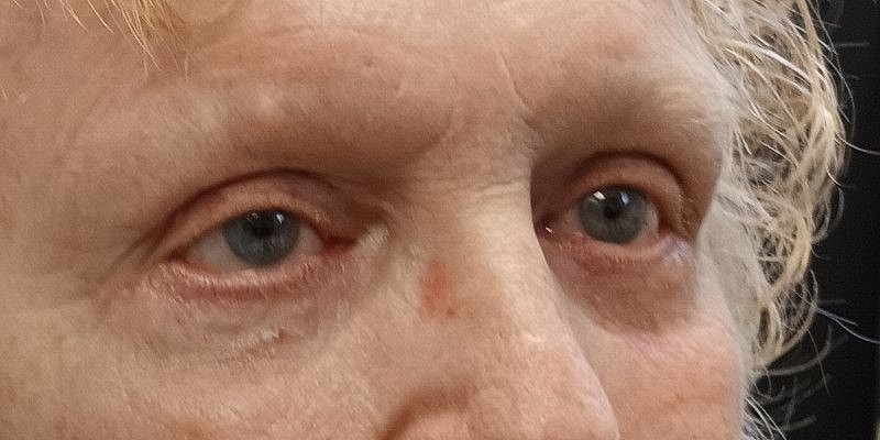 Eyelid Surgery Patrick Felice Before & After