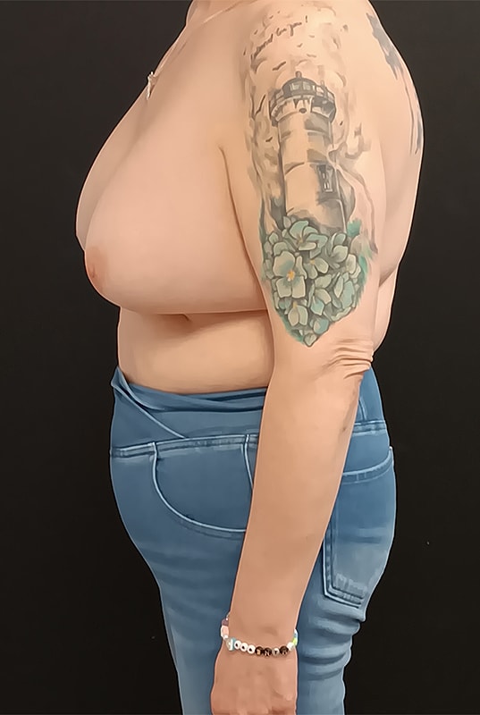Breast Implant Exchange Patrick Felice Before & After