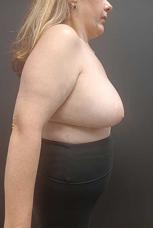 Breast Implant Exchange Patrick Felice Before & After