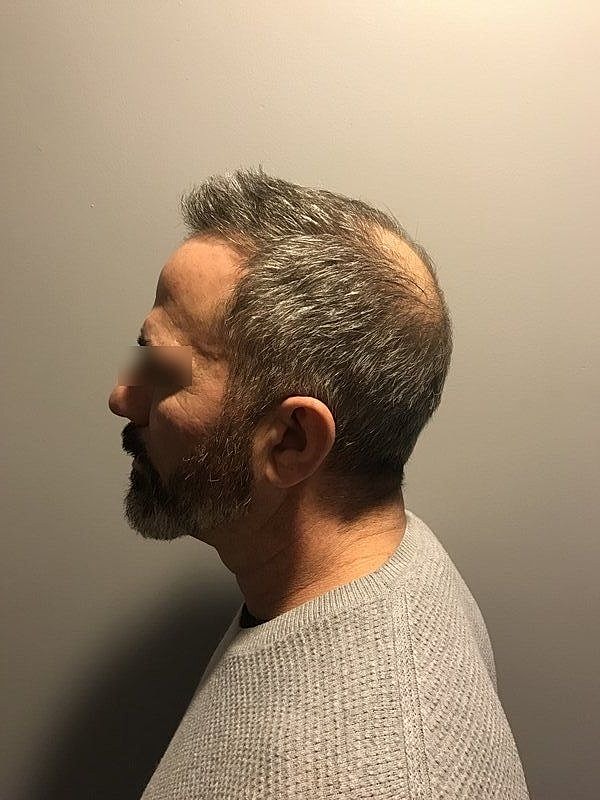 Before & After