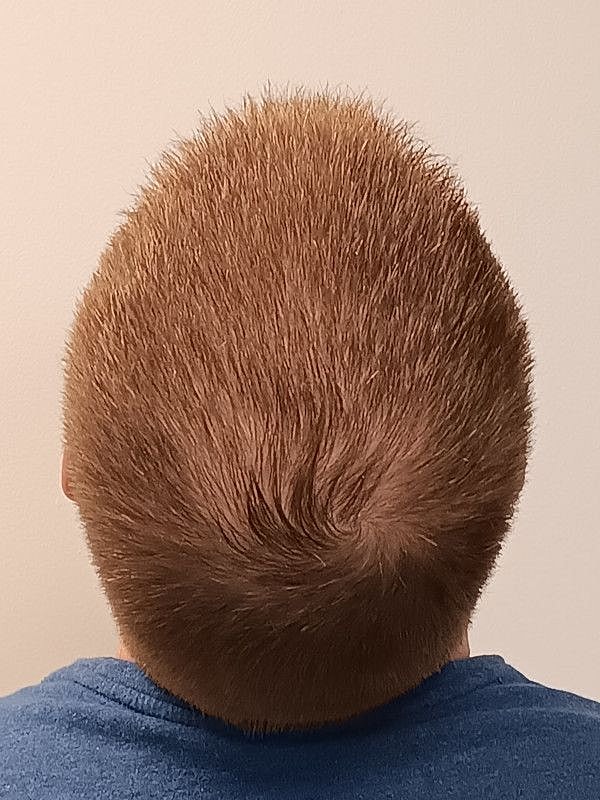 Hair Restoration Before & After