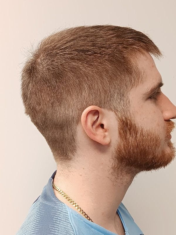 Hair Restoration Before & After