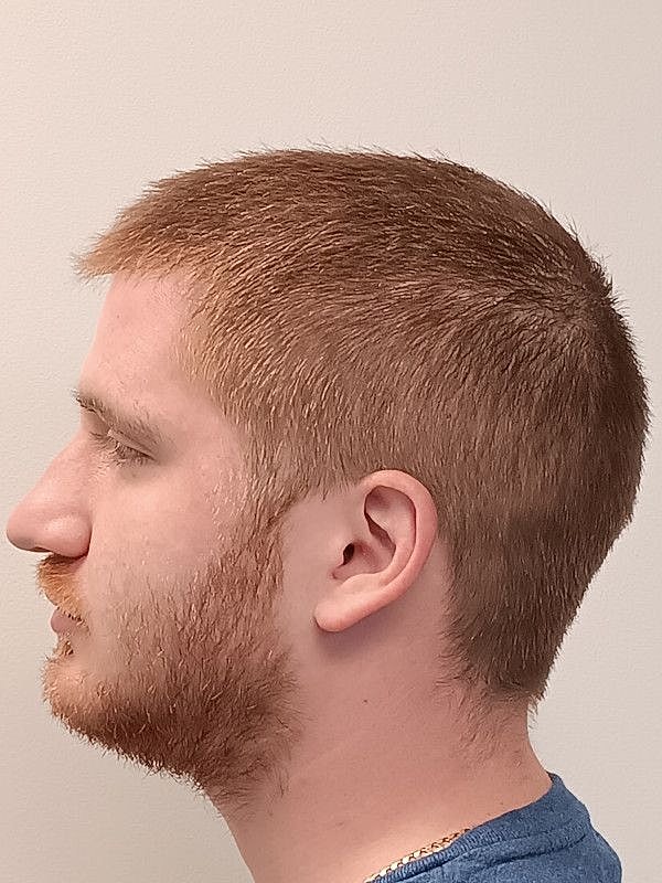 Hair Restoration Before & After