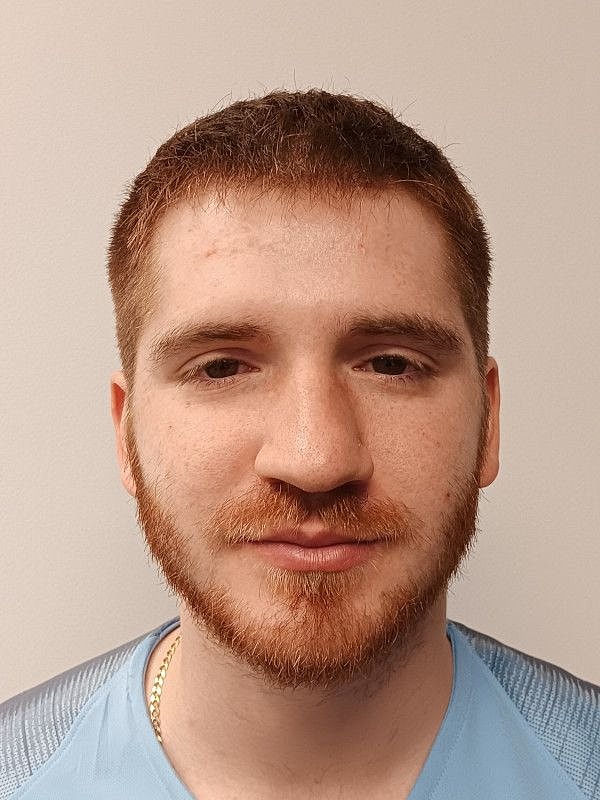 Hair Restoration Before & After