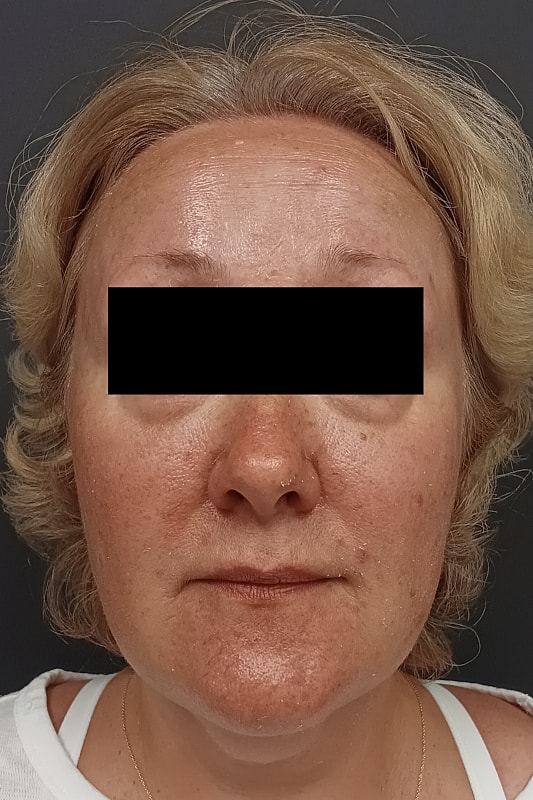 Facelift Patrick Felice Before & After