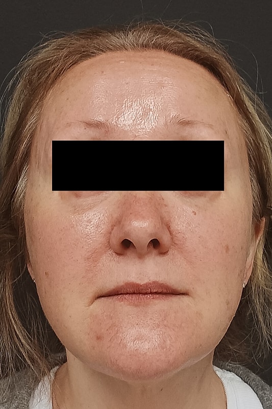 Facelift Patrick Felice Before & After