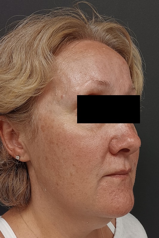 Facelift Patrick Felice Before & After