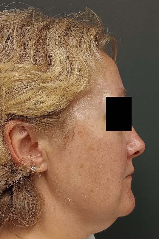 Facelift Patrick Felice Before & After