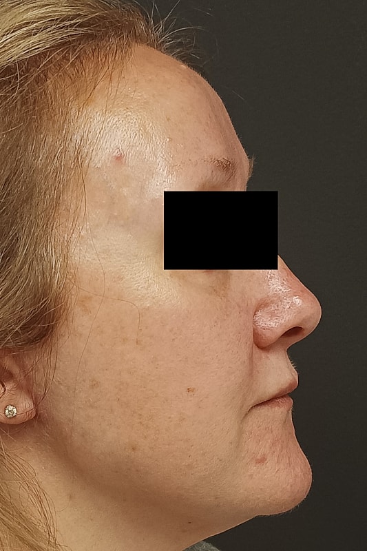 Facelift Patrick Felice Before & After