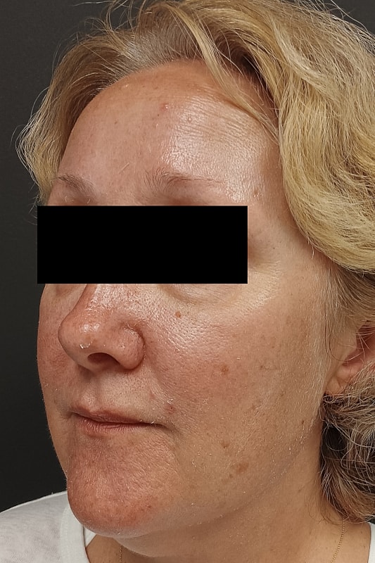 Facelift Patrick Felice Before & After