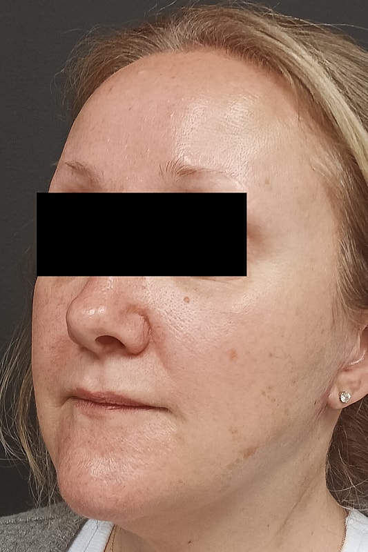 Facelift Patrick Felice Before & After