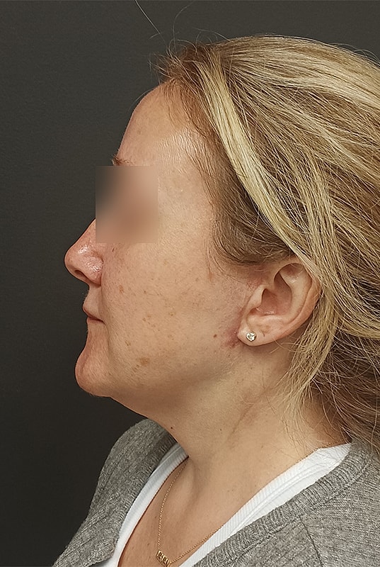 Facelift Patrick Felice Before & After