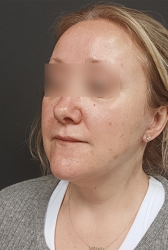 Facelift Patrick Felice Before & After