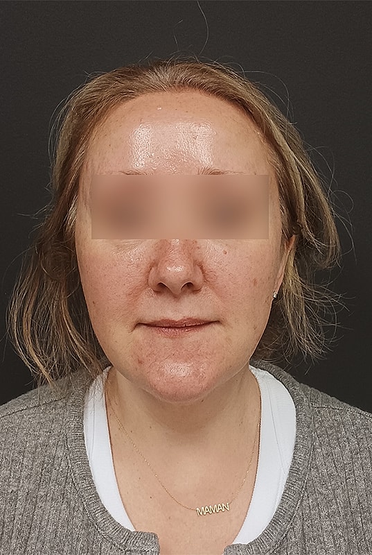 Facelift Patrick Felice Before & After