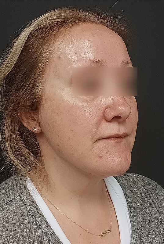 Facelift Patrick Felice Before & After