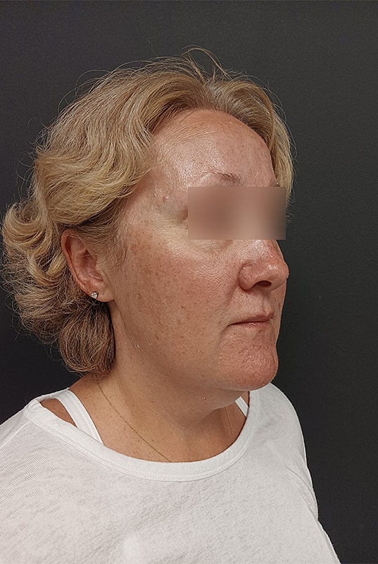 Facelift Patrick Felice Before & After