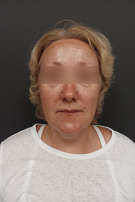 Facelift Patrick Felice Before & After