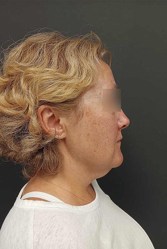 Facelift Patrick Felice Before & After